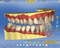 CEREC AC OMNICAM ПРОСТОЕ СКАНИРОВАНИЕ БЕЗ АНТИБЛИКОВОГО СПРЕЯ 18.jpg