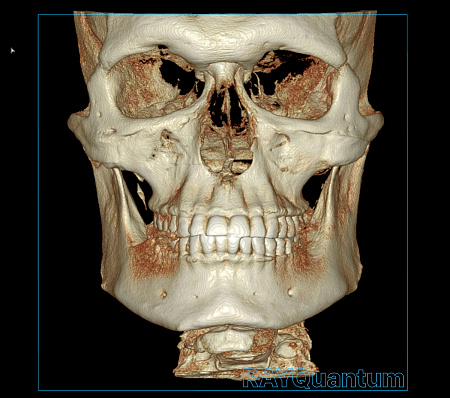 Ray α-SM3D Quantum – Дентальный томограф