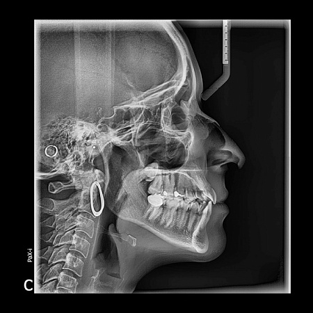 Vatech PaX-i 3D SC 10x8.5 - томограф с цефалостатом