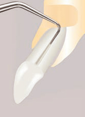 Acteon AS6D – Насадка с алмазным покрытием