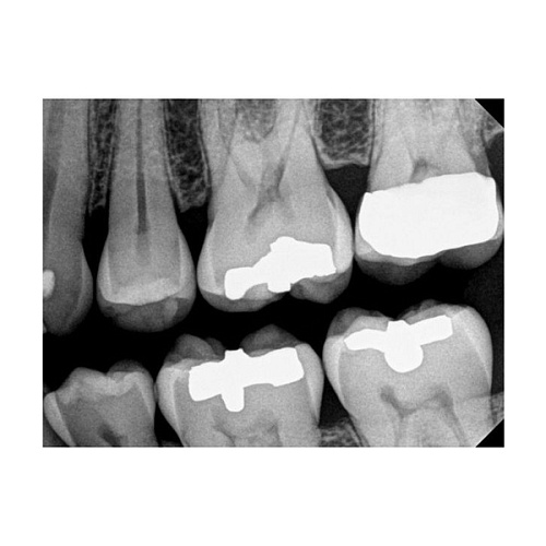 Carestream Kodak RVG 6200 - радиовизиограф
