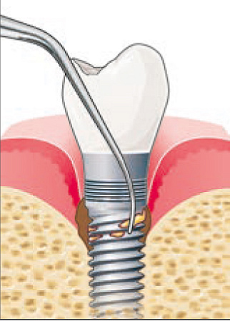 Acteon насадка IP2R – правосторонняя для обработки узкой и широкой резьбы имплантатов, абатментов